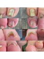 マシェリ ネイル(machErie Nail)&nbsp;巻き爪緩和施術もやっています。お問い合わせください^^
