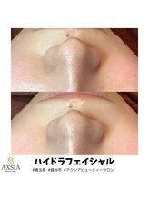 アクシア ビューティー サロン(AXSIA)/【ハイドラ】BeforeAfter