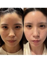 ルミナ シブヤ(LUMINA SHIBUYA)/シミケア5回目