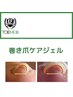 巻き爪ケアジェル【TOEMED】導入キャンペーン¥6500→¥5000