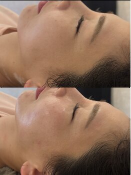 マホロバ(mahoroba)/ダーマ鍼で肌生き返り爆艶肌