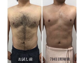 ホッコリ 府中店(HOKKORI)/【男女OK！】痛みの少ない脱毛