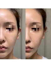 エシャーム(echarme)/Newアイス高周波