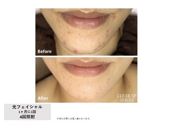 レア(Le'a)/【光フェイシャル】