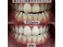 スペシャルホワイトニング１回で2～6トーンアップします！