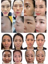 ベラ 東京院(Bella)/ICDインセルダム東京公式代理店