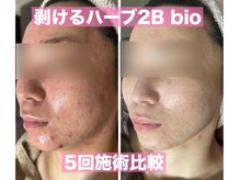 アブニールブリヨンの雰囲気（剥けるハーブはニキビの鎮静、ニキビケアが大得意！◎[肌質改善]）