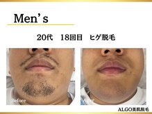 アルゴ 豊中岡町駅前店(ALGO)の雰囲気（【毎朝のヒゲ剃りから卒業】自己処理いらずの清潔感へ）