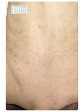 ピリナ 名古屋/【背中ハーブピーリング】症例