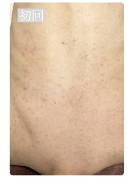 ピリナ 名古屋/【背中ハーブピーリング】症例