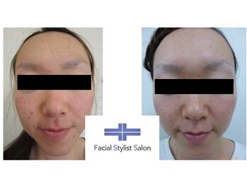 フェイシャルスタイリストサロン 高崎店(Facial Stylist Salon)/ケア例(58)
