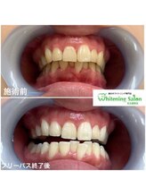 ホワイトニングサロン 名古屋駅店/【ホワイトニング施術例】