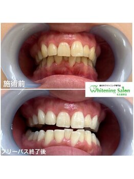 ホワイトニングサロン 名古屋駅店/【ホワイトニング施術例】