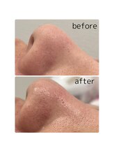 ムー(mu)/毛穴美人コース×光フェイシャル