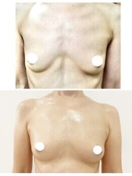 美人バスト 札幌店/バストアップ×育乳◇症例◇