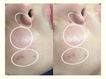 プティ 横浜店(Petit)/ララピールで肌管理