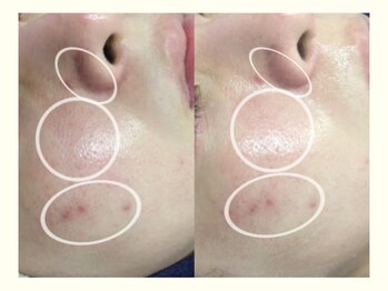 プティ 横浜店(Petit)/ララピールで肌管理