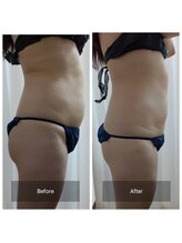 ビーアット(b-atto)/脂肪冷却ビフォーアフター