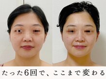 ジョンミー(JONMEE)の雰囲気（ハーブピーリングで毛穴・ニキビケア!銀座一丁目.たるみ毛穴）