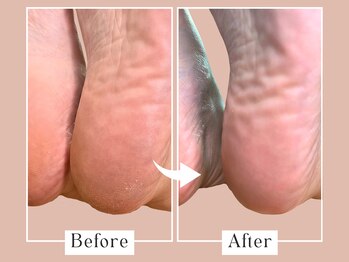 ベベ(Bebe)/40代女性/かかとガサガサお悩み