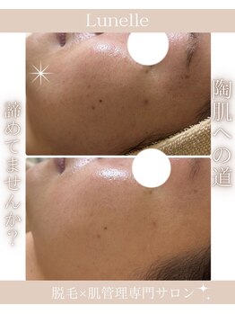 ルネル(Lunelle)/ハーブピーリングで陶器肌に♪