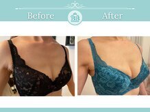 ベルビューティー(belle beauty)/【胸のたるみ・垂れ乳改善】症例
