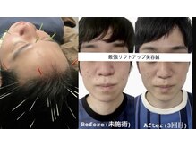 ヘッドサイエンス(HEADSCIENCE)/最強リフトアップ美容鍼
