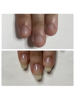 マニュコクーン(ManuCocoon)/爪育成 深爪 巻き爪 大阪市