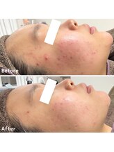 ニキビケア研究所 所沢店/赤みも引いていきます！