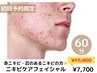 〈赤ニキビ・芯のあるニキビ〉ニキビケアフェイシャル60分