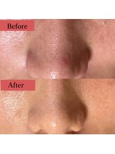 サロン ド エン(Salon de. en)/毛穴ケア◇ハーブピーリング