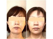 【たるみケア】フェイスライン、顎まわり二重あごが気になる方へ