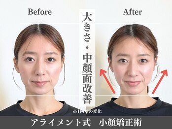 アライメントトウキョウ 恵比寿(Alignment TOKYO)/大きさ・中顔面改善
