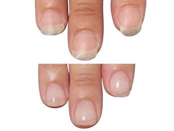 平らな爪!自爪育成