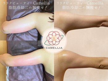 リラクビューティー カメリア(Camellia)の写真/薄着の季節に間に合う★脂肪冷却と電磁のＷアプローチで３０代からの頑固な二の腕とはみ肉を徹底引き締め！