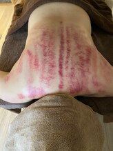 キコ リラクゼーションサロン(KICO by PLUS)/カッサでデトックス