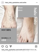ハル ハロ(halu halo)/脱毛