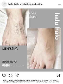 ハル ハロ(halu halo)/脱毛