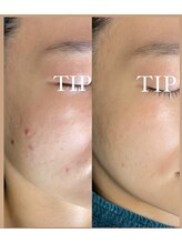 ビーピー 渋谷(b.p.)/ハーブピーリング