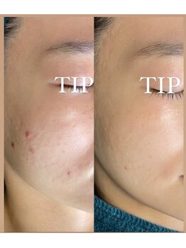 ビーピー 渋谷(b.p.)/ハーブピーリング