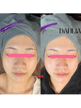 ダリア(Dahlia)/ハーブピーリング