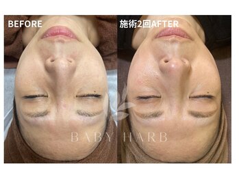 ビューティーサロンパピヨン 川口新井宿店/BABYHERB~ベビーハーブ~