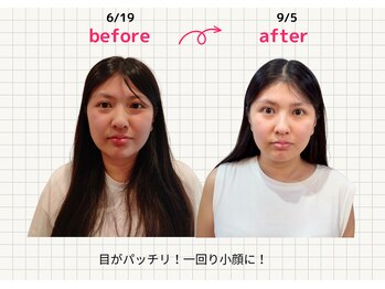 ナチュラルハリー(NaturalHarry)/当サロン自慢の経絡小顔施術!