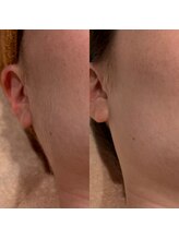 シノ 銀座(shino)/美顔シェービング