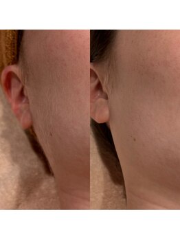 シノ 銀座(shino)/美顔シェービング