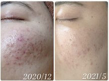 エル(Elle)/【肌質改善】ニキビ予防