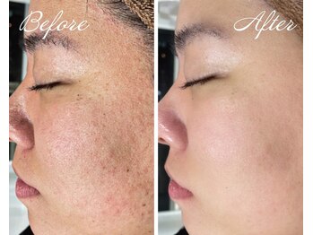 カシェボーテ(CACHE BEAUTE)/肌荒れ/肌のザラつきもお任せ♪