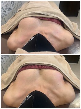 ロココ 天神店(Rococo)/バストアップ◇育乳症例◇