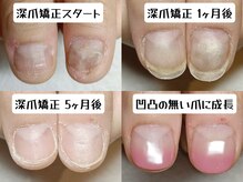 マニエネイル(mani e nail)/凹凸爪から美爪へ自爪育成