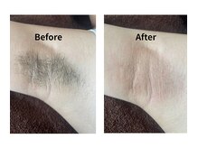 ジェンティル(Gentil)/わきワックス脱毛◎イベント前◎